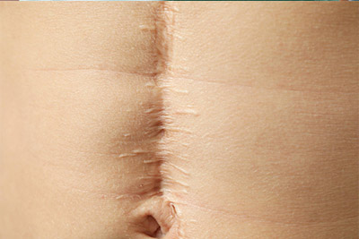 istanbul-yara-izi-onarimi